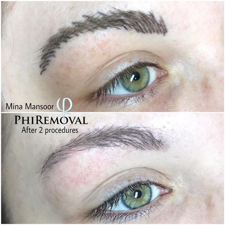 Permanent Make-Up Entfernung Berlin